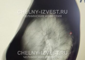 У жительницы Челнов во время прохождения диспансеризации в легком обнаружили иглу