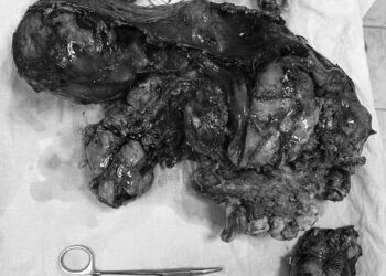 Хирурги РКБ удалили у женщины опухоль весом 11,3 кг