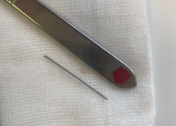 В Казани врачи ДРКБ извлекли иглу из печени ребенка