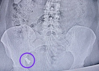 Врачи РКБ достали из кишечника 50-летней женщины зубной протез