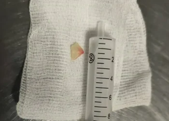 Врачи РКБ спасли 76-летнюю женщину, которая подавилась квашеной капустой