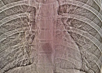 В Челнах 13-летняя девочка случайно проглотила зубную щетку